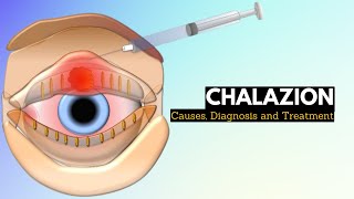 CHALAZION Causes Signs and Symptoms Diagnosis and Treatment [upl. by Hadsall]