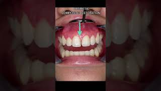 Immediate Fix for GAPS OR SPACES for your front teeth DIASTEMA CLOSURECOSMETIC RESTORATION shorts [upl. by Ellemrac362]