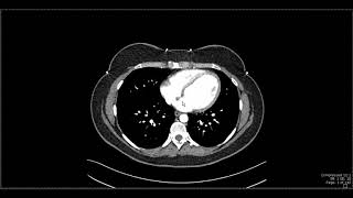 Abdominal Anatomy on Computed Tomography [upl. by Eneri]