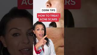 How to Treat Acne Scars According to a Dermatologist shorts [upl. by Thema]