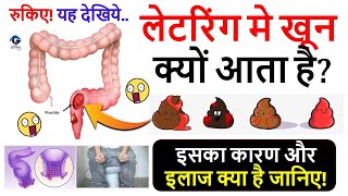 लेटरिंग मे खून क्यों आता है इसके कारणजाँच और इलाज देखिये  Blood In Stool  Gyanvid Nuskhe [upl. by Ettevets264]