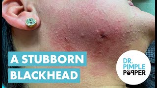 Dr Pimple Popper Helps With Blackhead Cyst [upl. by Auhsuj469]