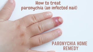 Paronychia home remedy  How to treat paronychia an infected nail [upl. by Eidnak]