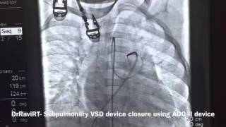 DrRaviRT  Subpulmonary VSD device closure using ADOII device [upl. by Eronaele932]