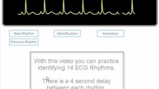 ECG Rhythm Review of 14 common rhythms [upl. by Pelag65]