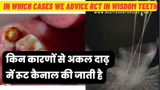 Root Canal Treatment on Wisdom Teeth Pros and Cons Dr Praveen Bhatia rct teeth [upl. by Normac]