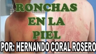 RONCHAS EN LA PIEL [upl. by Morgan]