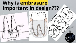 Importance of embrasure in oral health [upl. by Eytak220]