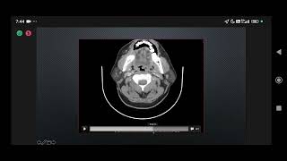 NBE UNDERSTANDING HEAD amp NECK SPACES WHAT SURGICAL ONCOLOGIST NEEDS TO KNOW DR DIVA SHAH [upl. by Nnylasor]