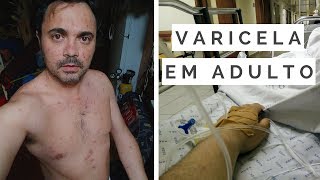 VARICELA EM ADULTO  A minha experiência [upl. by Dahsraf165]