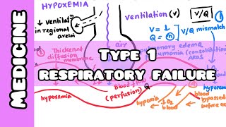 Type 1 Respiratory Failure made simple for USMLE NEET PG [upl. by Eidod669]