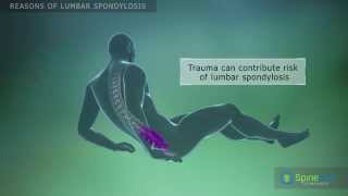 Lumbar Spondylosis Reasons [upl. by Nyral]