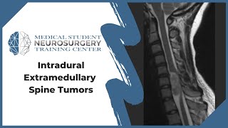 Intradural Extramedullary Spine Tumors [upl. by Barfuss]