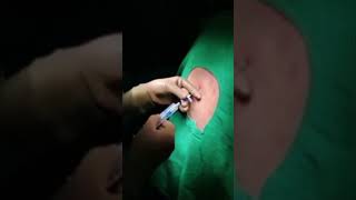 Epidural Catheter Insertion Technique epidural [upl. by Eenram]