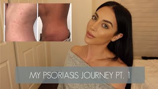 PSORIASIS JOURNEY PT 1  HOW I CLEARED MY PSORIASIS AND GOT MY LIFE BACK [upl. by Neelyhtak]