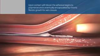 VenaSeal Closure System animation [upl. by Ireva]