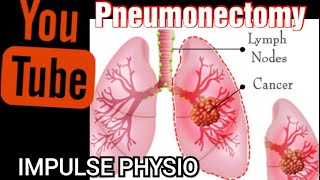 Pneumonectomy Impulse physio [upl. by Brodsky982]