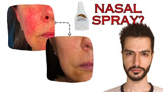 Rosacea Redness treatment with a Nasal Spray  Mo React [upl. by Eberhart]