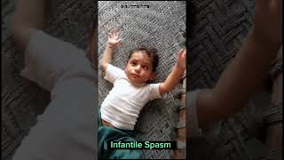 Infantile Spasm fits seizures infantilespasm epilepsy treatment [upl. by Irakab]