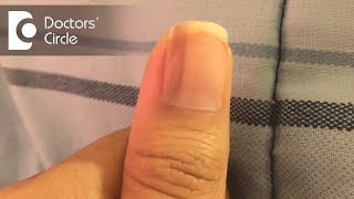 What causes vertical black lines on fingernails  Dr Aruna Prasad [upl. by Rayna]