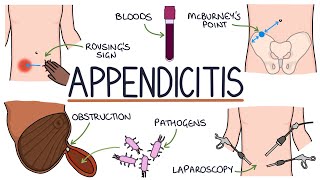 Understanding Appendicitis [upl. by Wiles]