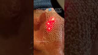 Improving skin texture with CO2 Laser laserskinrejuvenation co2laser oddlysatisfying [upl. by Acenes]