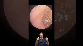 I Cant Hear From Using Ear Plug Deep Ear Wax  EP1005 [upl. by Acino742]