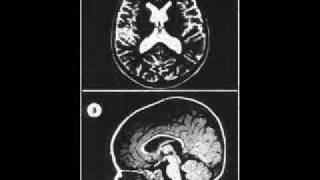 Sotos Syndrome [upl. by Jemimah]