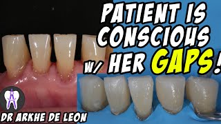 Closing The Patients Gaps with Direct Composite Technique C24 [upl. by Alitta]