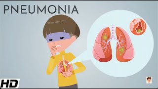 Pneumonia Everything You Need To Know [upl. by Beck]