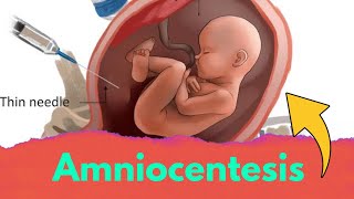 Amniocentesis class 12 biology  Amniocentesis test [upl. by Mehcanem]