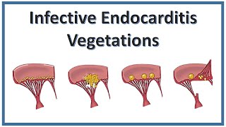 Vegetations Infective Endocarditis  NEET PG  Pathology  Medicine [upl. by Kinnie]