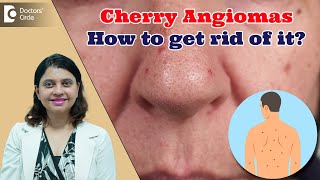 RED DOTS ON SKIN  Cherry Angioma amp its Treatment  Red Moles  Dr Amee Daxini  Doctors Circle [upl. by Assirok]