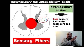 Difference Between Intramedullary and Extramedullary lesions Neurology cme محاضراتباطنة [upl. by Ezekiel]