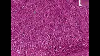 Histopathology Soft tissueFibrosarcoma [upl. by Malaspina]