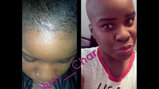 How To CombatCure Alopecia Hair Loss With Biotin amp Pumpkin Seed Oil [upl. by Gilburt809]