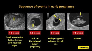 Early Pregnancy Failure A simplified Ultrasound Approach [upl. by Aninaj]