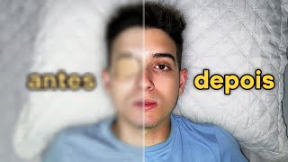 ANTES E DEPOIS minha cirurgia a LASER nos olhos [upl. by Owen]