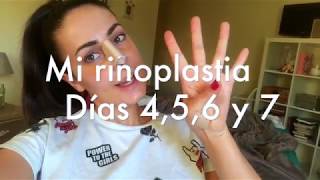 Mi rinoplastia día 45 6 y 7¡¡¡ ¿Que productos utilizo ¿Puedo respirar [upl. by Alica]