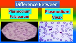 Distinction Between Plasmodium Falciparum and Plasmodium Vivax [upl. by Patty]