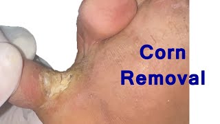 Athletes foot Removal  Fungal skin infection athletefoot [upl. by Wain]