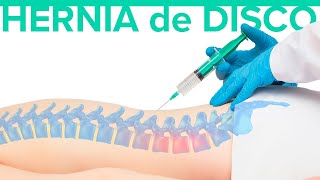 Cuál es el MEJOR TRATAMIENTO para la hernia discal 🦾 Hernia de disco [upl. by Airlee]