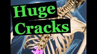 AWESOME Full Spine Chiropractic Adjustment with Huge Cracks [upl. by Abbotsen584]