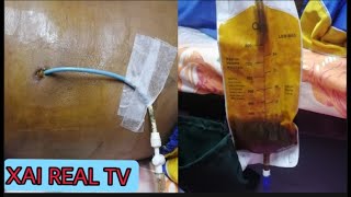 PTBDPercutaneous Transhepatic Billiary Drainage PERSONAL EXPERIENCE Ep3 [upl. by Kohn211]