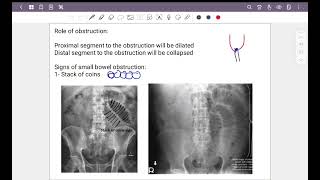 Abdominal radiograph part 2  small amp large bowel obstruction [upl. by Ecilegna]