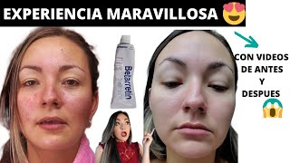 RETINOL ANTES Y DESPUES😱 TRETINOINA MI EXPERIENCIA DESPUES DE 6 MESES betarretin acido retinoico [upl. by Gader645]