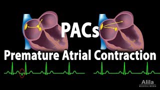 Premature Atrial Contractions PACs Animation [upl. by Ulla]