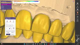 Exocad 31 WAX UP FULL MODEL easy to make difikult work [upl. by Suiram]