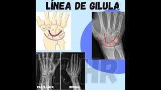 Luxación del carpo Línea de gilula medicina hueso huesos manoshorts [upl. by Aicek]