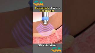 Peyronies desase treatment doctor  viral video  biology [upl. by Blinny]